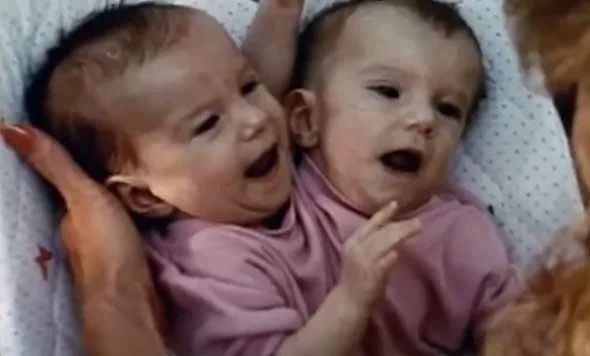 Двухголовая девушка, самые известные сиамские близнецы в мире