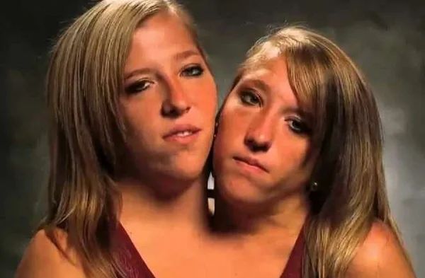 Двухголовая девушка, самые известные сиамские близнецы в мире