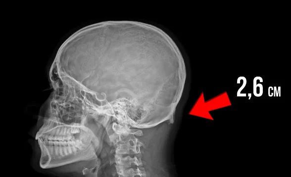 Необычные мутации у людей и наросты на черепе от частого использования смартфонов
