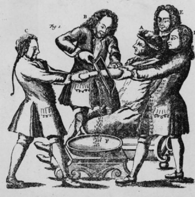 Как Людовик XIV Французский и его геморрой изменили отношение к хирургам